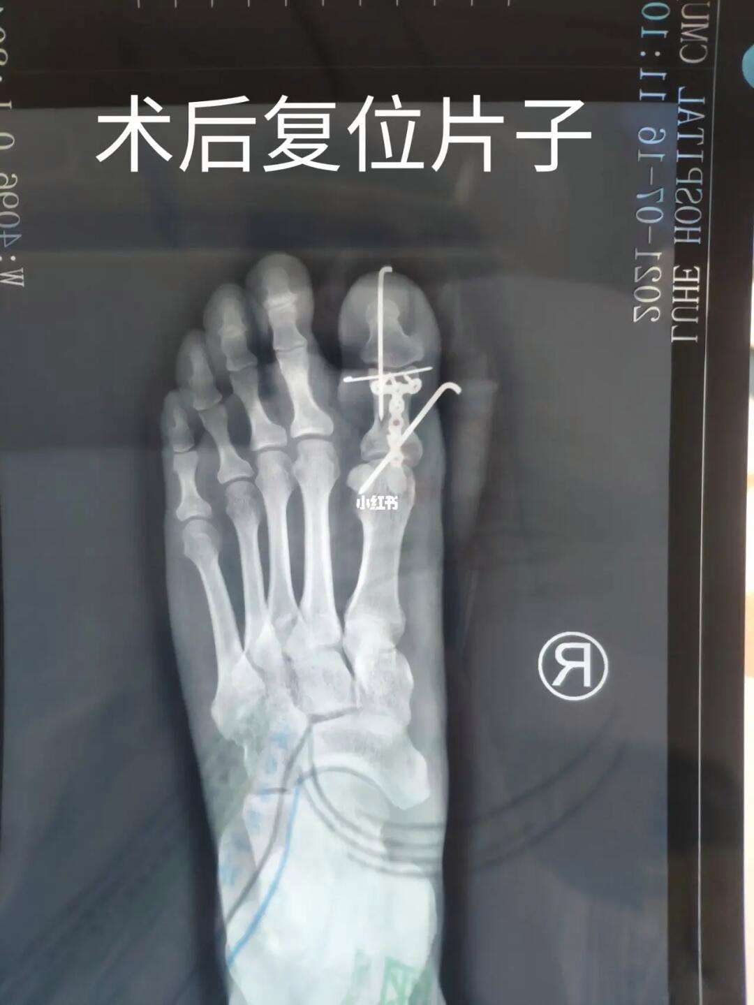 灰熊JJJ正式接受脚趾手术三个月后重新评估的简单介绍