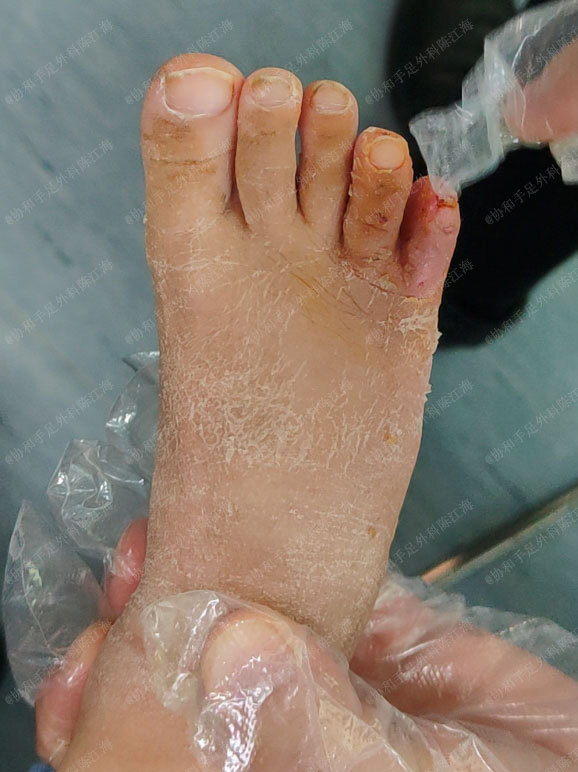 灰熊JJJ正式接受脚趾手术三个月后重新评估的简单介绍